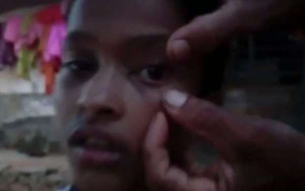 Indian Girl Has Ants Pulled From Her Eyes Every Day And No One Knows How They Get There